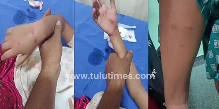 child-injured-by-stray-dogs-attack-in-surathkal