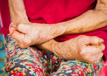 ಕರಾವಳಿಯಲ್ಲಿ ಕುಷ್ಠರೋಗ ಹೆಚ್ಚಳ : ನಿರ್ಲಕ್ಷ್ಯದಿಂದ ಗಂಭೀರ ಹಂತಕ್ಕೆ ತಲುಪುತ್ತಿರುವ ರೋಗ