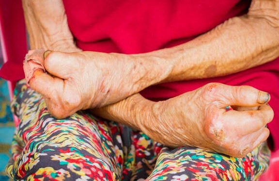 ಕರಾವಳಿಯಲ್ಲಿ ಕುಷ್ಠರೋಗ ಹೆಚ್ಚಳ : ನಿರ್ಲಕ್ಷ್ಯದಿಂದ ಗಂಭೀರ ಹಂತಕ್ಕೆ ತಲುಪುತ್ತಿರುವ ರೋಗ