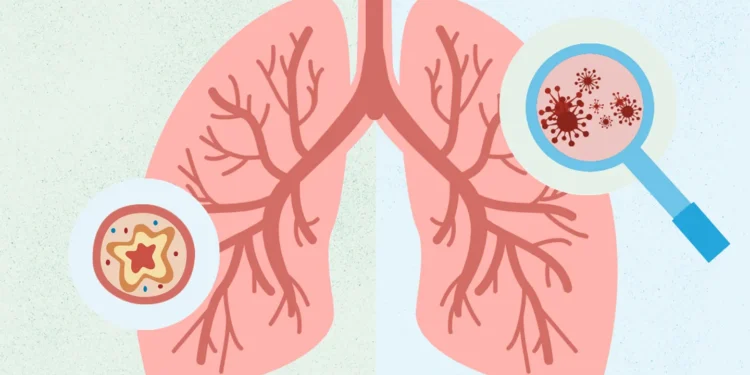 ವಯಸ್ಕರಲ್ಲಿ ಅಸ್ತಮಾ ಅಪಾಯ ಕಡಿಮೆ ಮಾಡಬಹುದೇ? ಅಧ್ಯಯನ ಏನು ಹೇಳುತ್ತದೆ ?