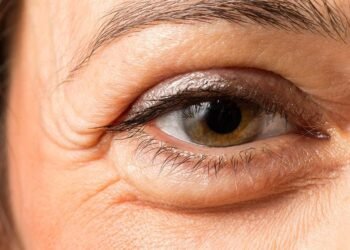 ಕಣ್ಣುಗಳ ಊತ ಕಡಿಮೆಯಾಗುತ್ತಿಲ್ಲವೇ? ಅದು ಕಿಡ್ನಿ ಸಮಸ್ಯೆಯ ಎಚ್ಚರಿಕೆಯಾಗಿರಬಹುದು