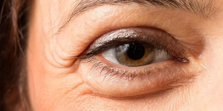 ಕಣ್ಣುಗಳ ಊತ ಕಡಿಮೆಯಾಗುತ್ತಿಲ್ಲವೇ? ಅದು ಕಿಡ್ನಿ ಸಮಸ್ಯೆಯ ಎಚ್ಚರಿಕೆಯಾಗಿರಬಹುದು