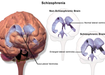 ‘ಸ್ಕಿಜೋಫ್ರೇನಿಯಾ’ ನಮ್ಮ ದೇಹದ ಯಾವ ಅಂಗಕ್ಕೆ ಸೇರಿದ ಕಾಯಿಲೆ?