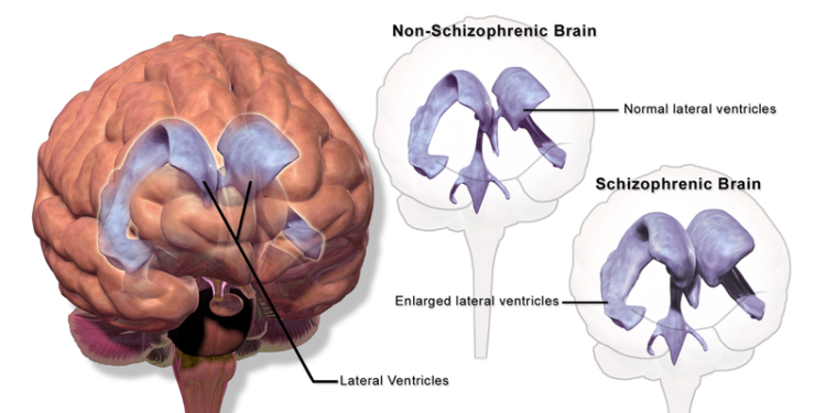 ‘ಸ್ಕಿಜೋಫ್ರೇನಿಯಾ’ ನಮ್ಮ ದೇಹದ ಯಾವ ಅಂಗಕ್ಕೆ ಸೇರಿದ ಕಾಯಿಲೆ?
