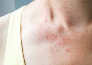 ಬೇಸಿಗೆಯಲ್ಲಿ ಬೆವರುಕಜ್ಜಿಗೆ ಕಾರಣಗಳು, ಲಕ್ಷಣಗಳು ಮತ್ತು ಪರಿಣಾಮಕಾರಿ ಪರಿಹಾರಗಳು