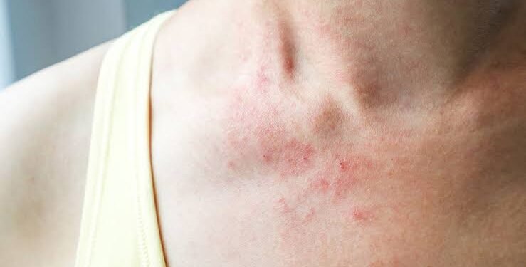 ಬೇಸಿಗೆಯಲ್ಲಿ ಬೆವರುಕಜ್ಜಿಗೆ ಕಾರಣಗಳು, ಲಕ್ಷಣಗಳು ಮತ್ತು ಪರಿಣಾಮಕಾರಿ ಪರಿಹಾರಗಳು