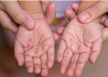 What precautions should be taken if children have hand, foot, and mouth disease?