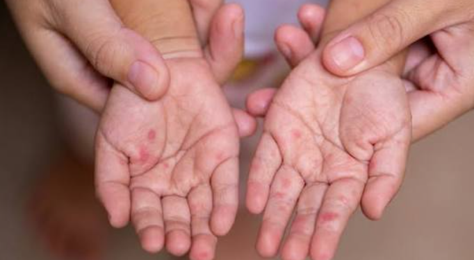 What precautions should be taken if children have hand, foot, and mouth disease?