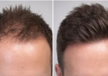Hair growth in just a few weeks: New plant-based serum, caution needed