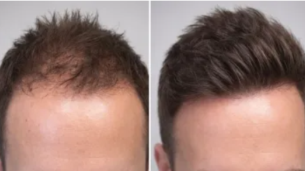Hair growth in just a few weeks: New plant-based serum, caution needed