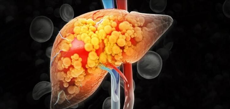 ಫ್ಯಾಟಿ ಲಿವರ್ ಇರುವವರು ತಪ್ಪದೇ ತಿಳಿಯಬೇಕಾದ ಆಹಾರ ಸಲಹೆಗಳು